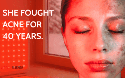 Red Light Therapy for Acne: From Teen Drama to Menopause Magic