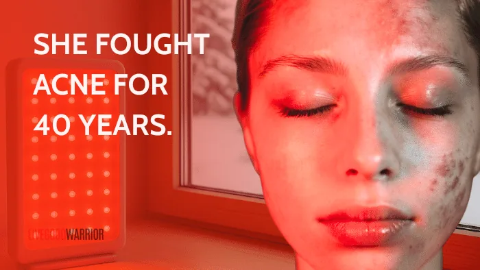 Red Light Therapy for Acne: From Teen Drama to Menopause Magic